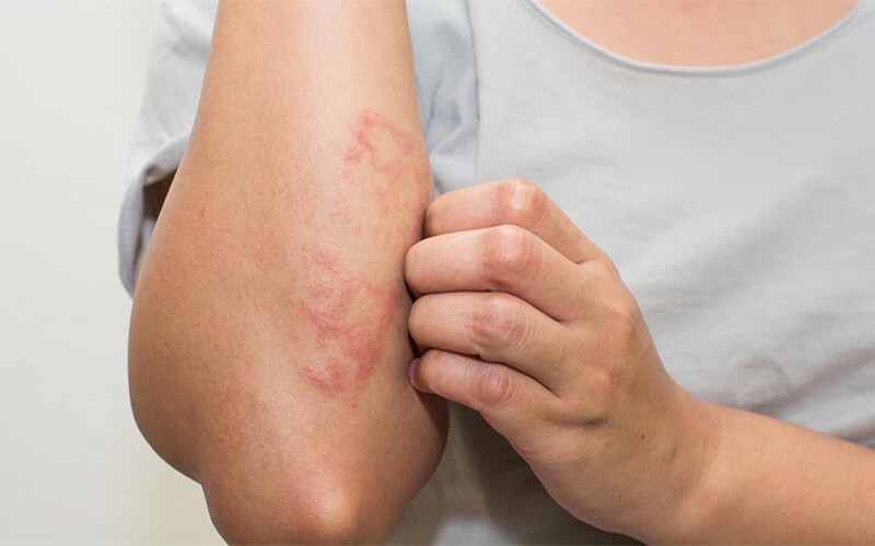 di-ung-da-do-khong-ve-sinh-voi-sen-tam di ung da do khong ve sinh voi sen tam